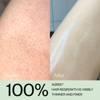 Hair Growth Inhibitor Serum