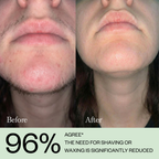 Hair Growth Inhibitor Serum