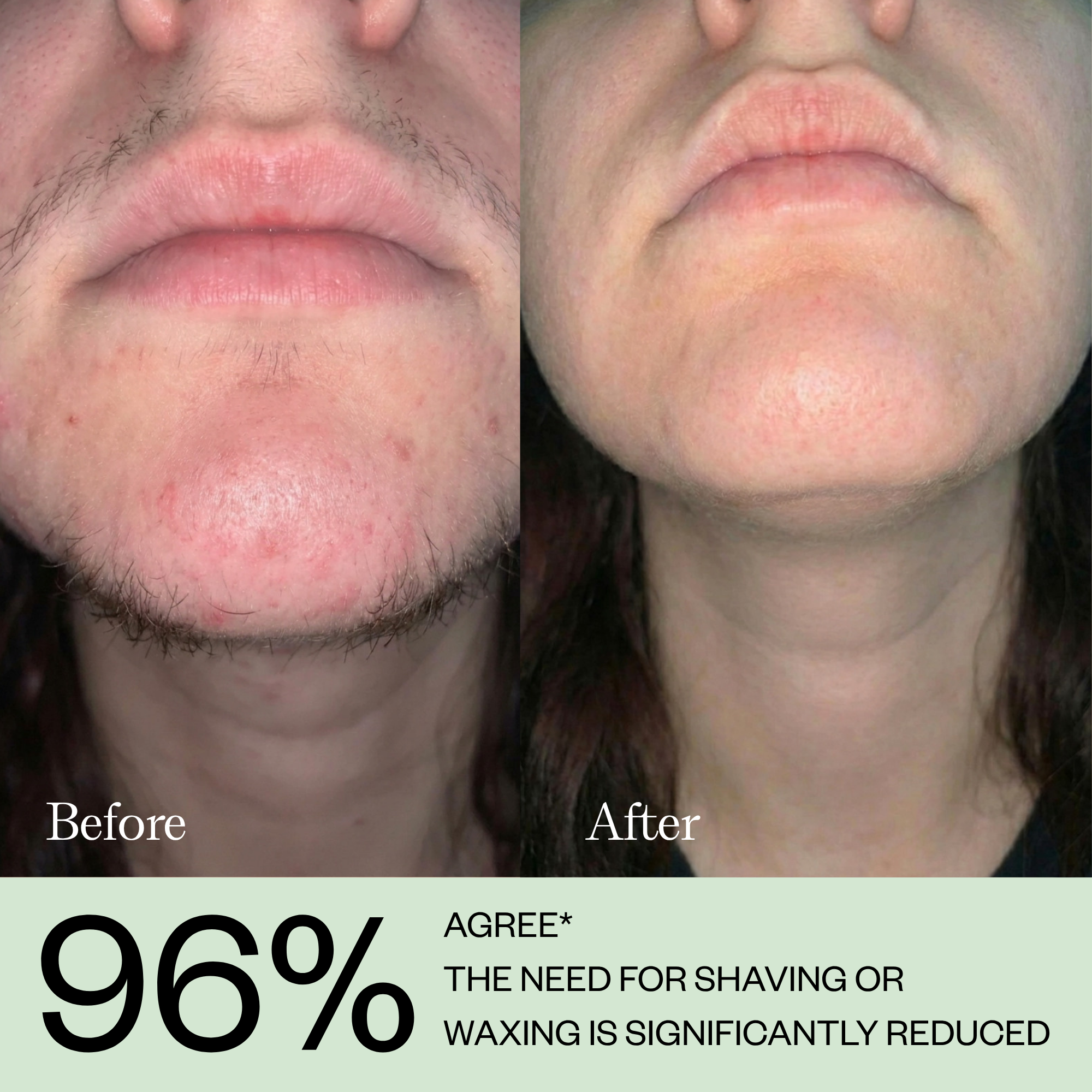 Hair Growth Inhibitor Serum